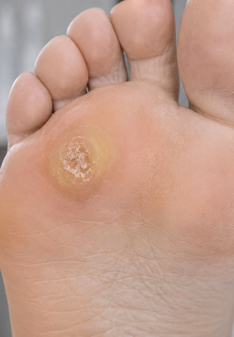 Close-up of hyperkeratosis on the foot